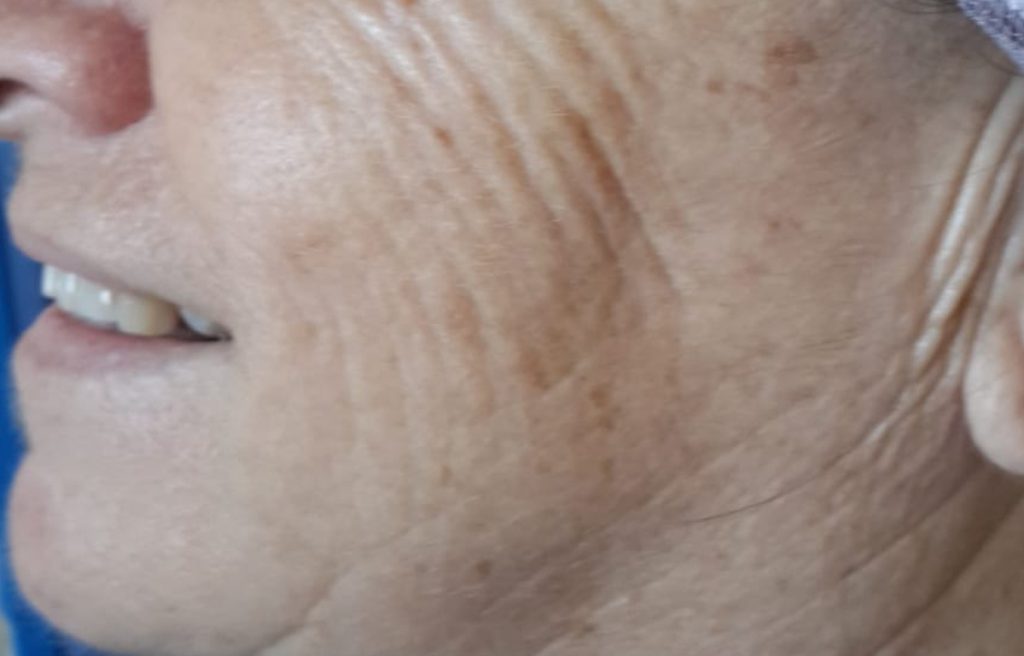 איך למנוע קמטים