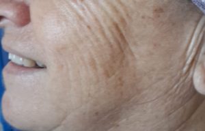 איך למנוע קמטים